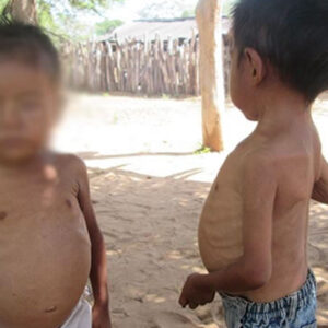 Desnutrición Aguda Infantil