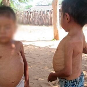 Lineamientos para el manejo integrado de la desnutrición aguda modera y severa en niños y niñas de 0 a 59 meses de edad.